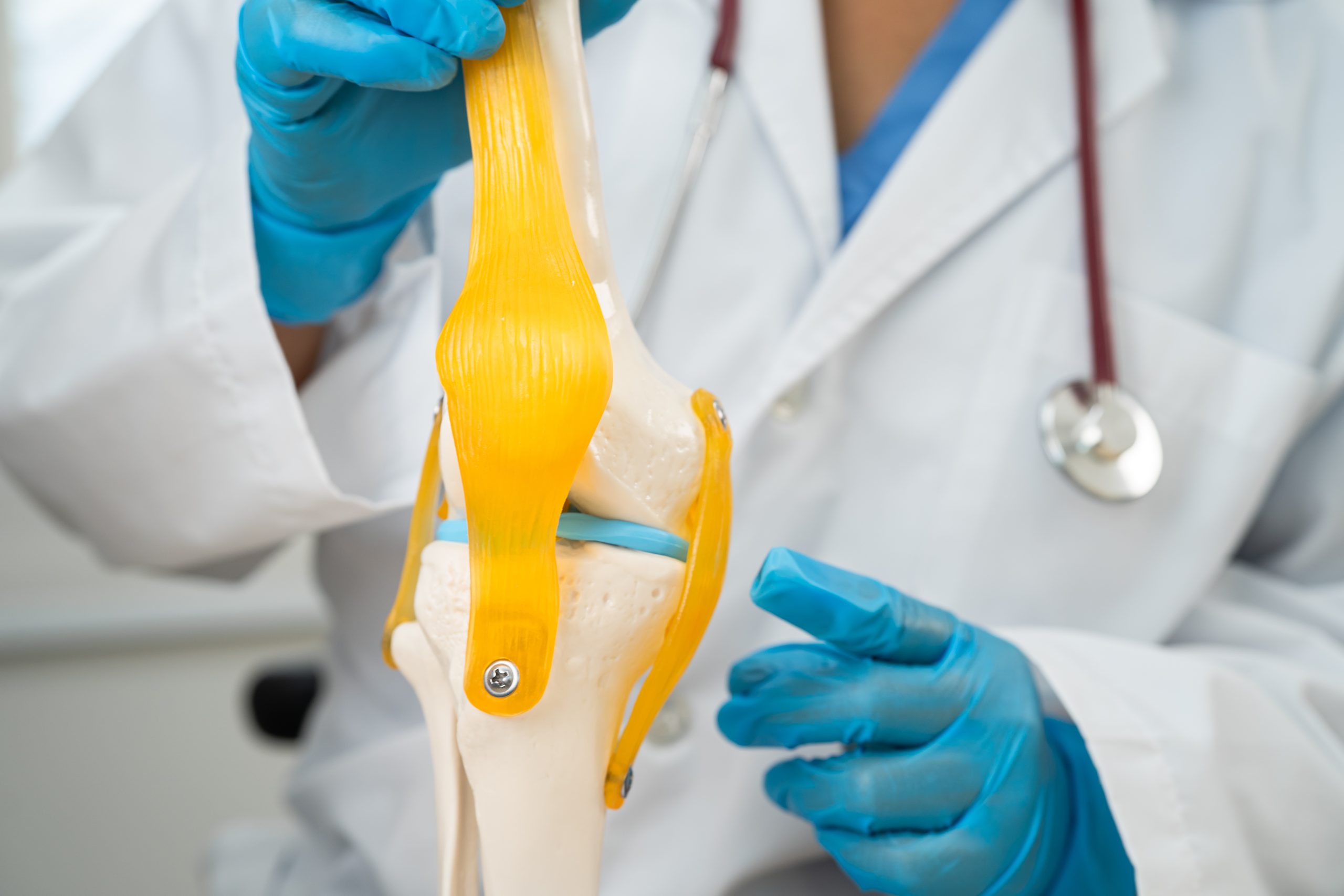 Osteoarthritis of the knee, Doctor holding human knee joint orth